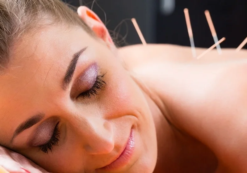 Dry needling treatment being performed on a patient's upper back